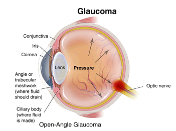 glaucoma-diagram