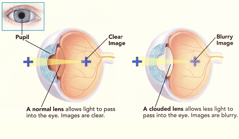 what-is-a-cataract